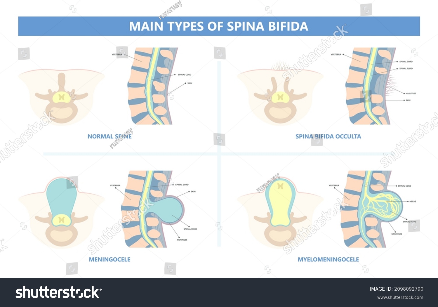 Spina Bifida Pregnancy Non Invasive Neural Stock Vector (Royalty Free ...