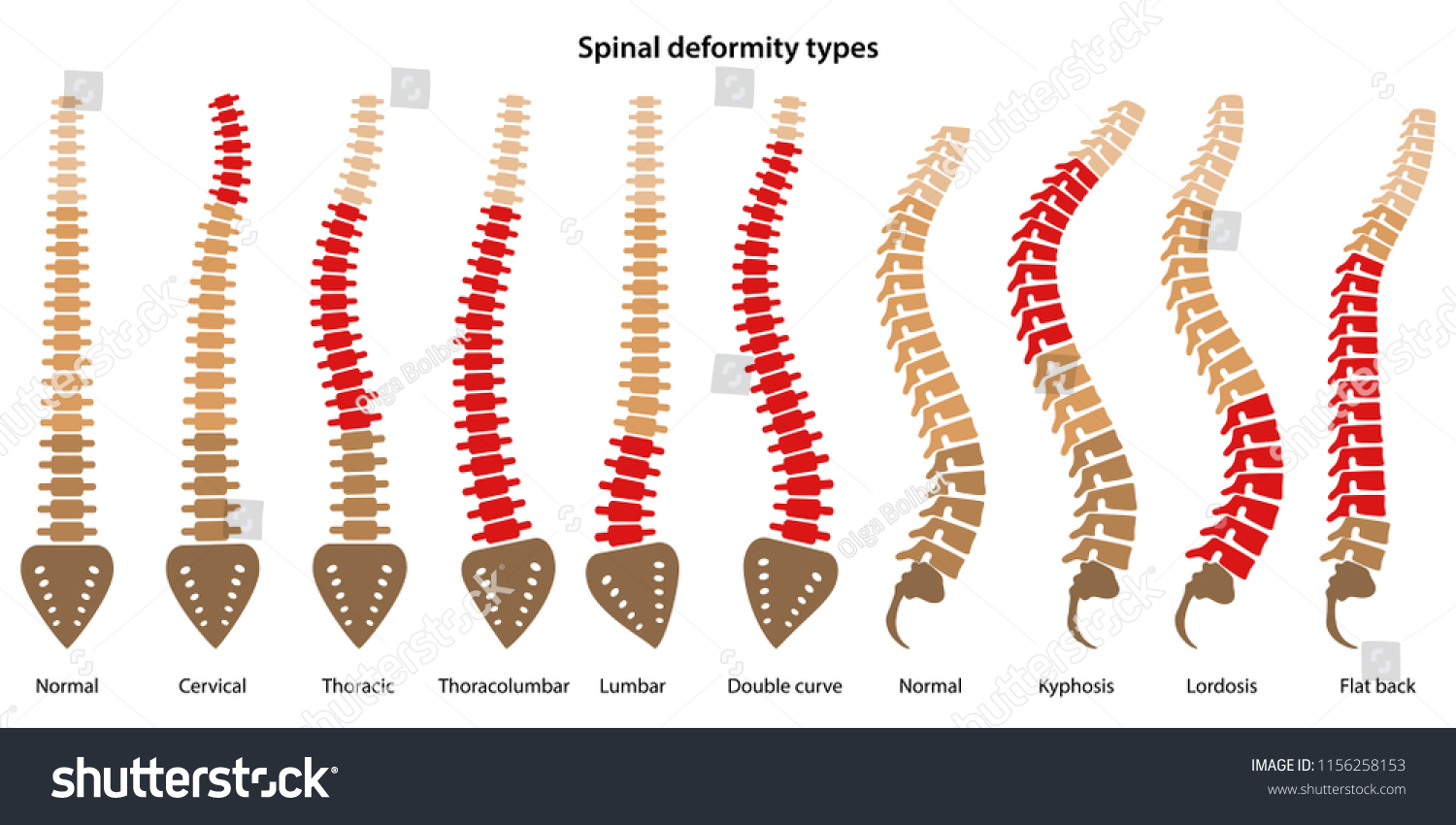 vektor-stok-spinal-deformity-types-diagram-marked-sections-tanpa