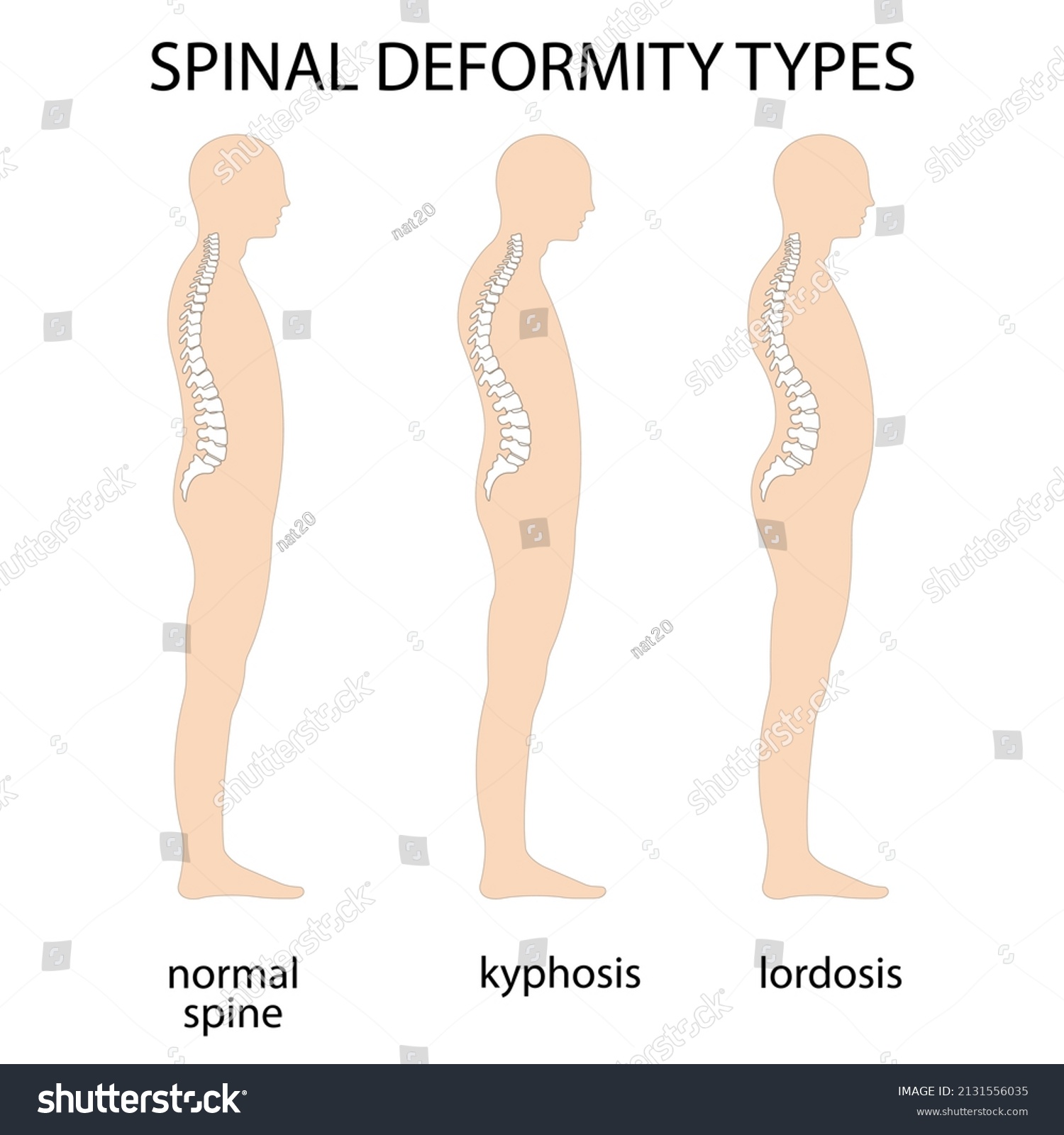 Spine Deformity Vector Illustration Kyphosis Lordosis Stock Vector Royalty Free