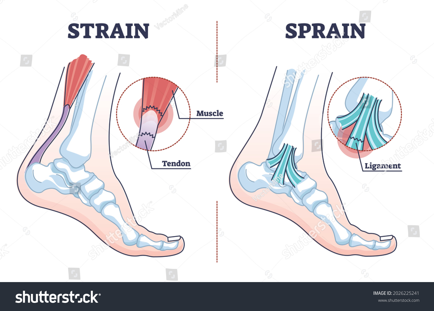 17-616-sprains-and-strains-images-stock-photos-vectors-shutterstock