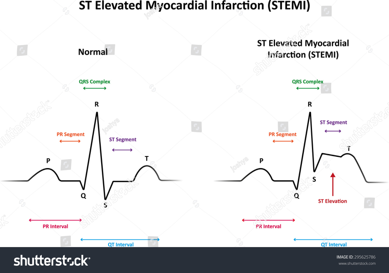 St Elevated Myocardial Infarction Stemi Stock Vector 295625786 ...