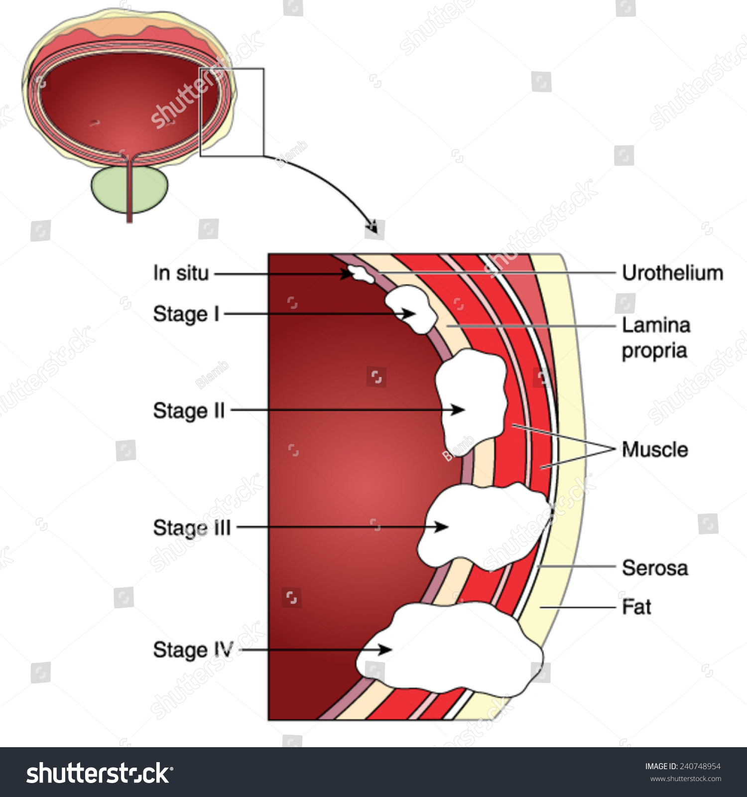 Stages Bladder Cancer Insitu Stage Iv: Vector De Stock (libre De ...