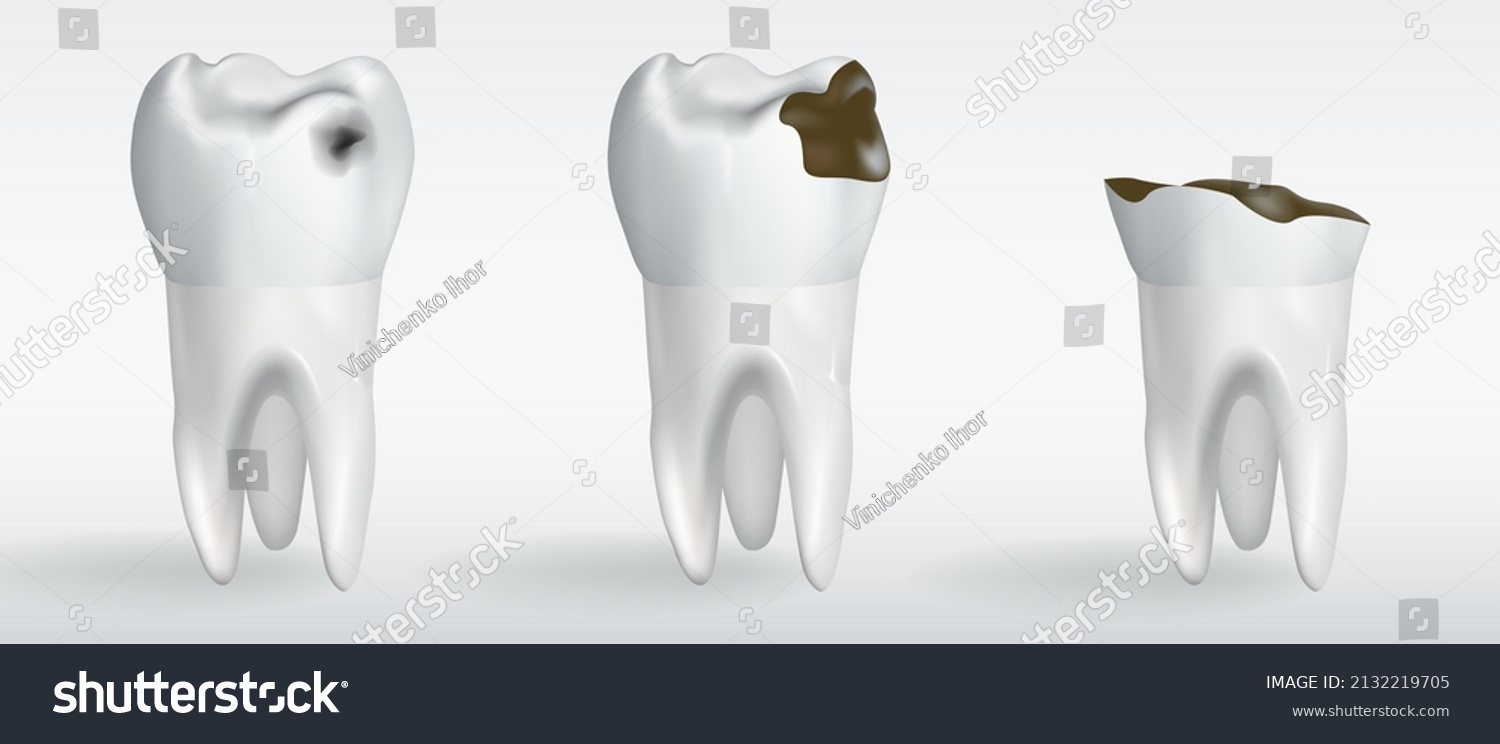 Stages Caries Stages Tooth Decay Vector Stock Vector (Royalty Free ...