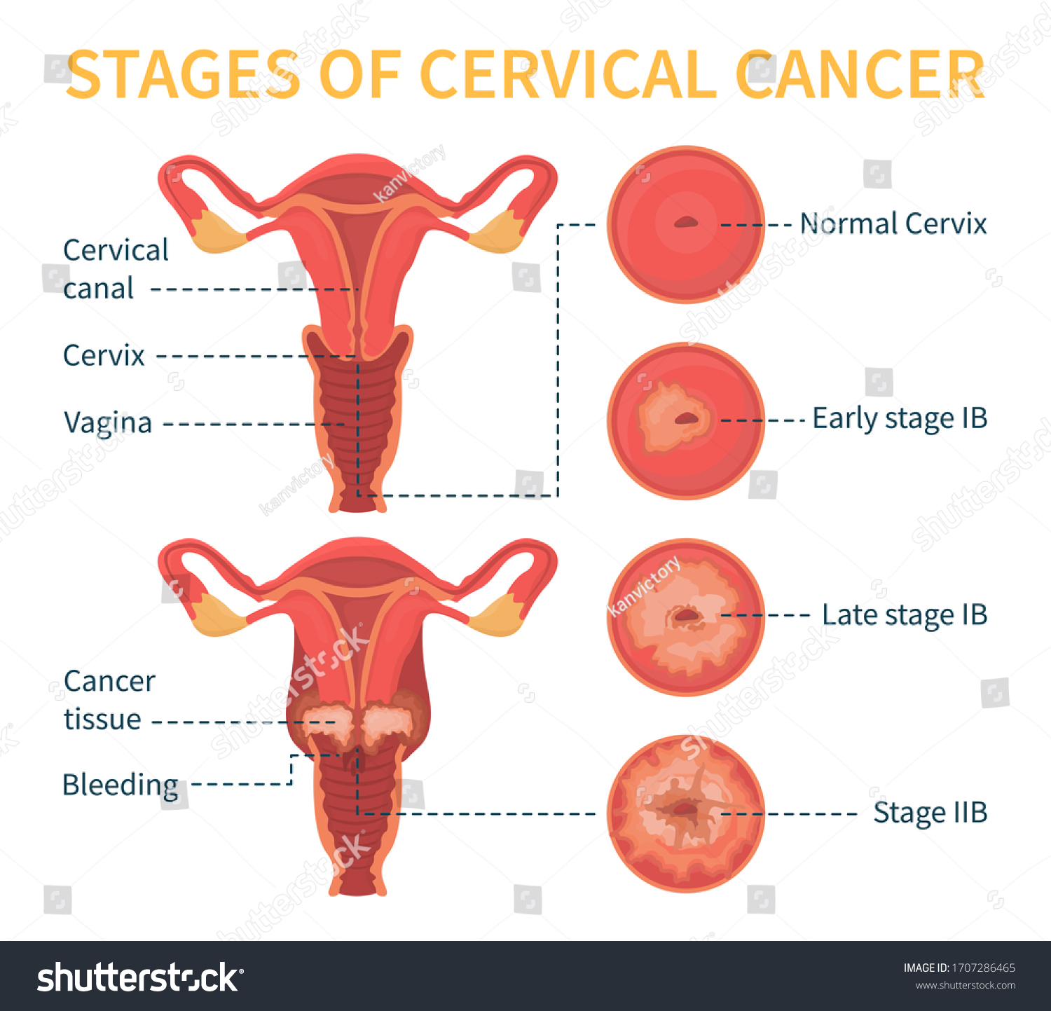 Stages Cervical Cancer Womens Reproductive System Stock Vector Royalty Free 1707286465 