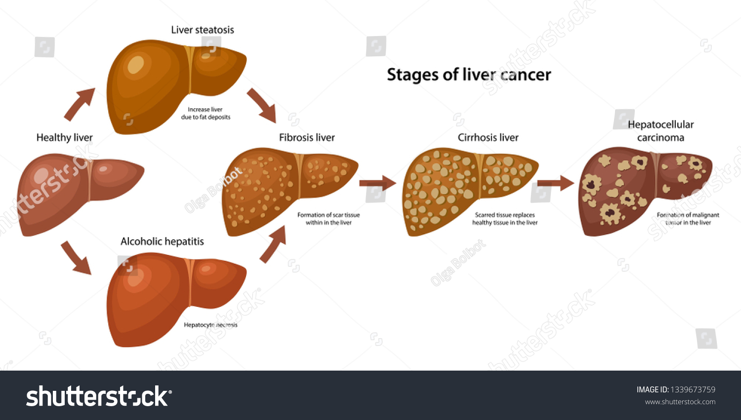 Stages Liver Cancer Description Corresponding Steps Stock Vector Royalty Free 1339673759