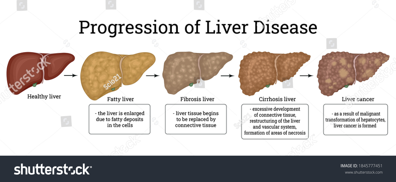 Stages Liver Damage Such Fatty Liver Stock Vector (Royalty Free ...