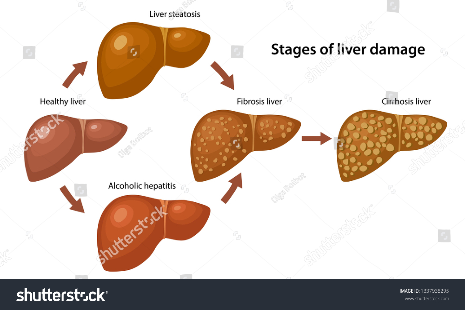 Stages Liver Damage Description Corresponding Steps Stockvector