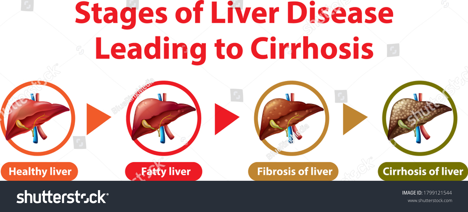 Stages Liver Disease Leading Cirrhosis Illustration Stock Vector Royalty Free 1799121544 1005