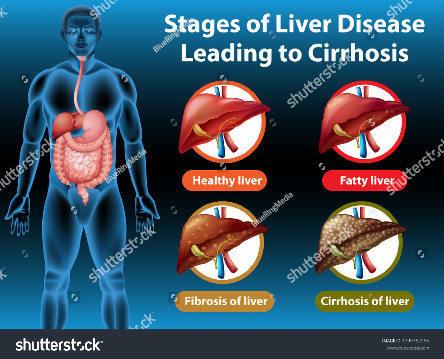 Stages Liver Disease Leading Cirrhosis Illustration 库存矢量图（免版税）1799762965 Shutterstock