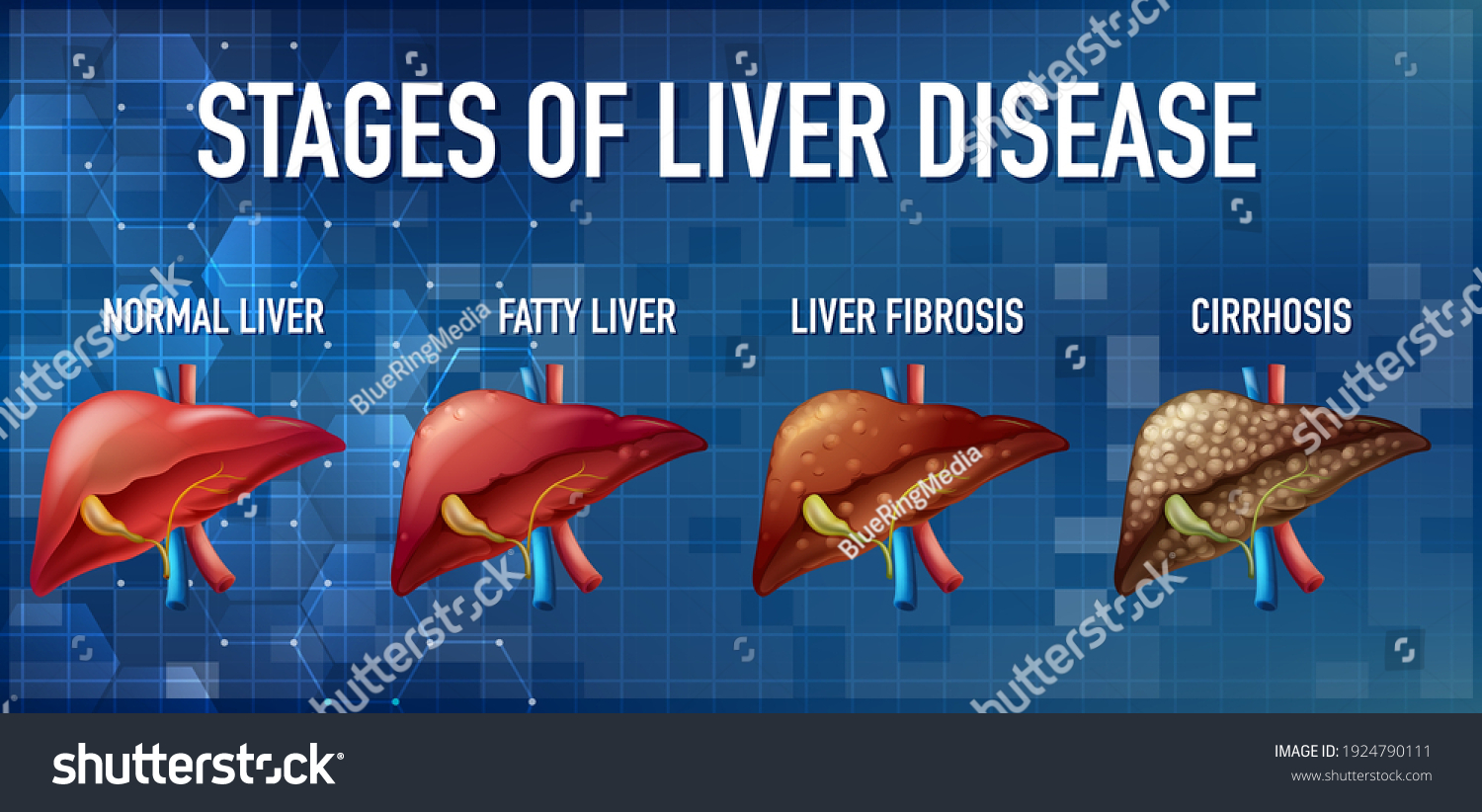 Stages Liver Disease Leading Cirrhosis Illustration Stock Vector ...
