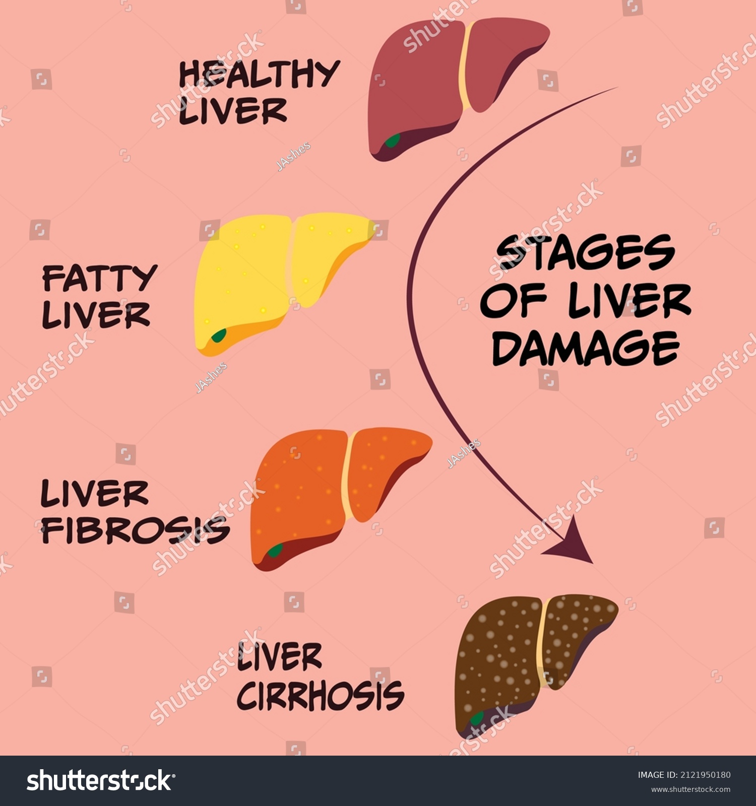 Liver Disease Progression Chart 3519