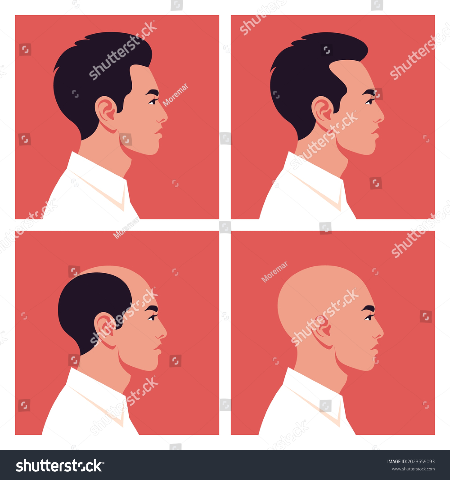 Stages Male Pattern Baldness Hair Loss Stock Vector Royalty Free