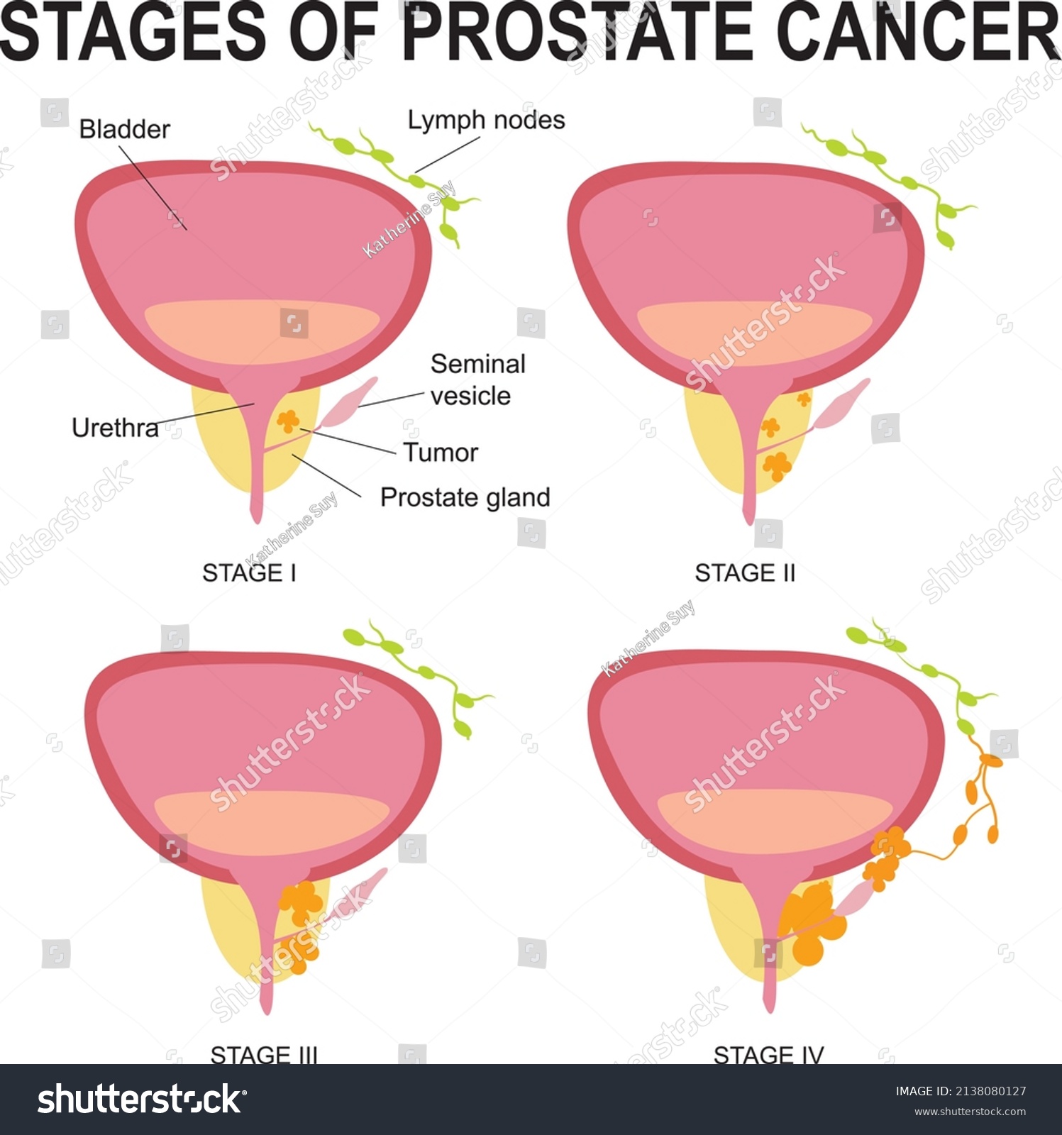 Stages Prostate Cancerdestruction Male Gland Development Stock Vector ...