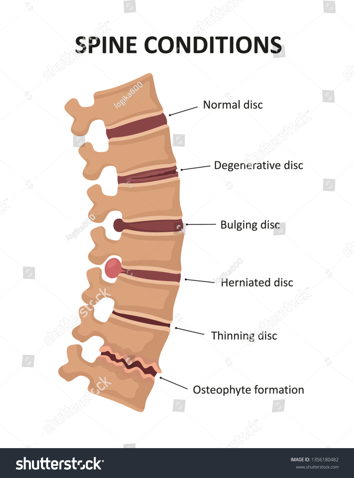 spinal osteochondrosis