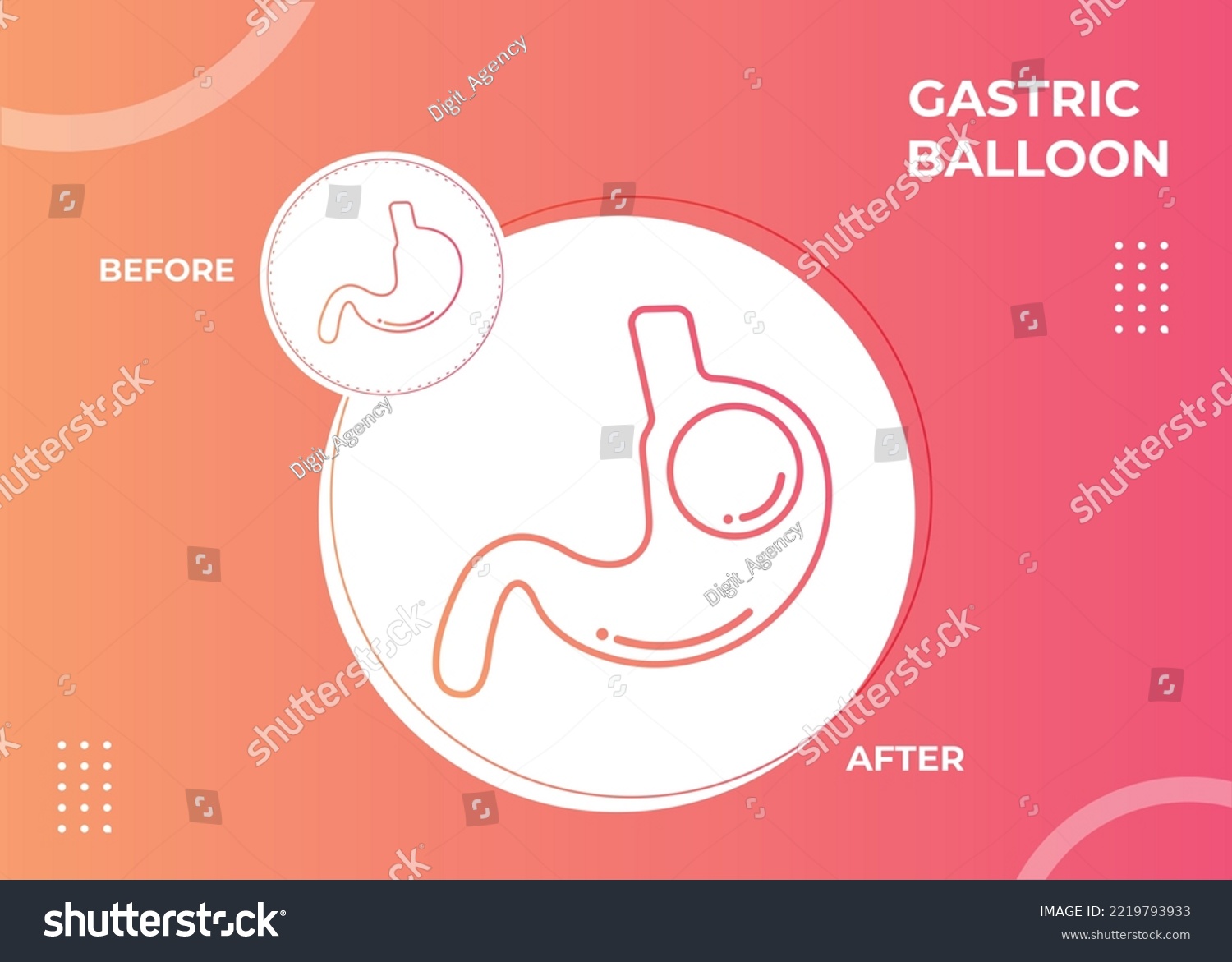 SVG of Stomach Endoscopy Gastric Balloon Inside a Stomach weight loss surgery vector illustration obesity 
 svg