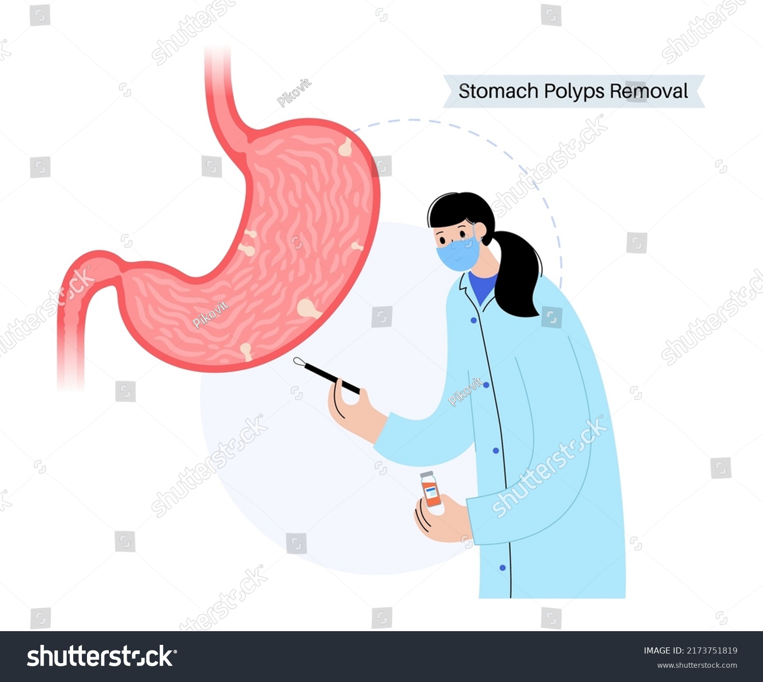 Stomach Polyps Diagnostic Removal Consultation Doctor Stock Vector Royalty Free 2173751819