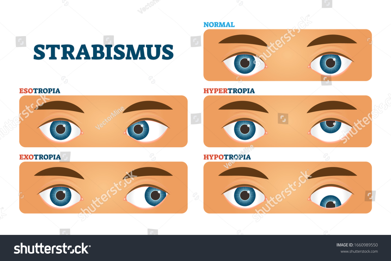 Strabismus Cross Eyed Vision Condition Vector Stock Vector Royalty Free