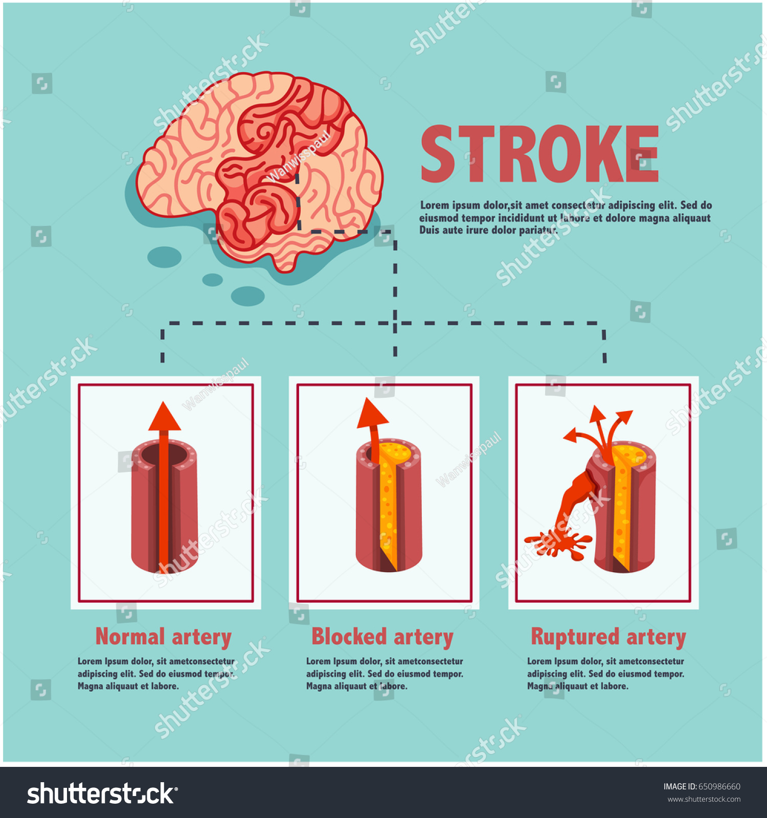 Stroke Disease Ischemic Hemorrhagic Blocked Ruptured Stock Vector 650986660 Shutterstock