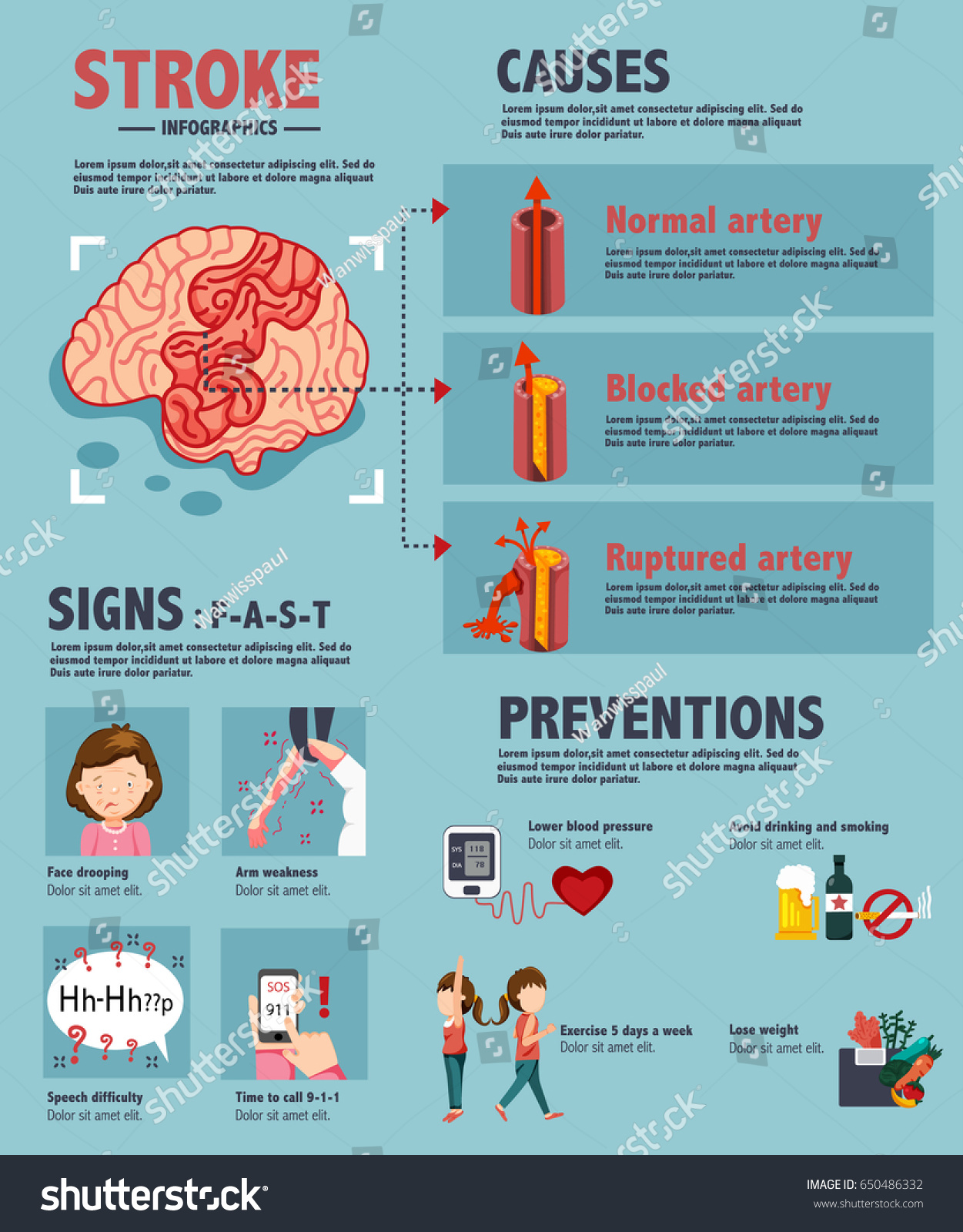 Vektor Stok Stroke Ischemic Hemorrhagic Disease Medical Infographics