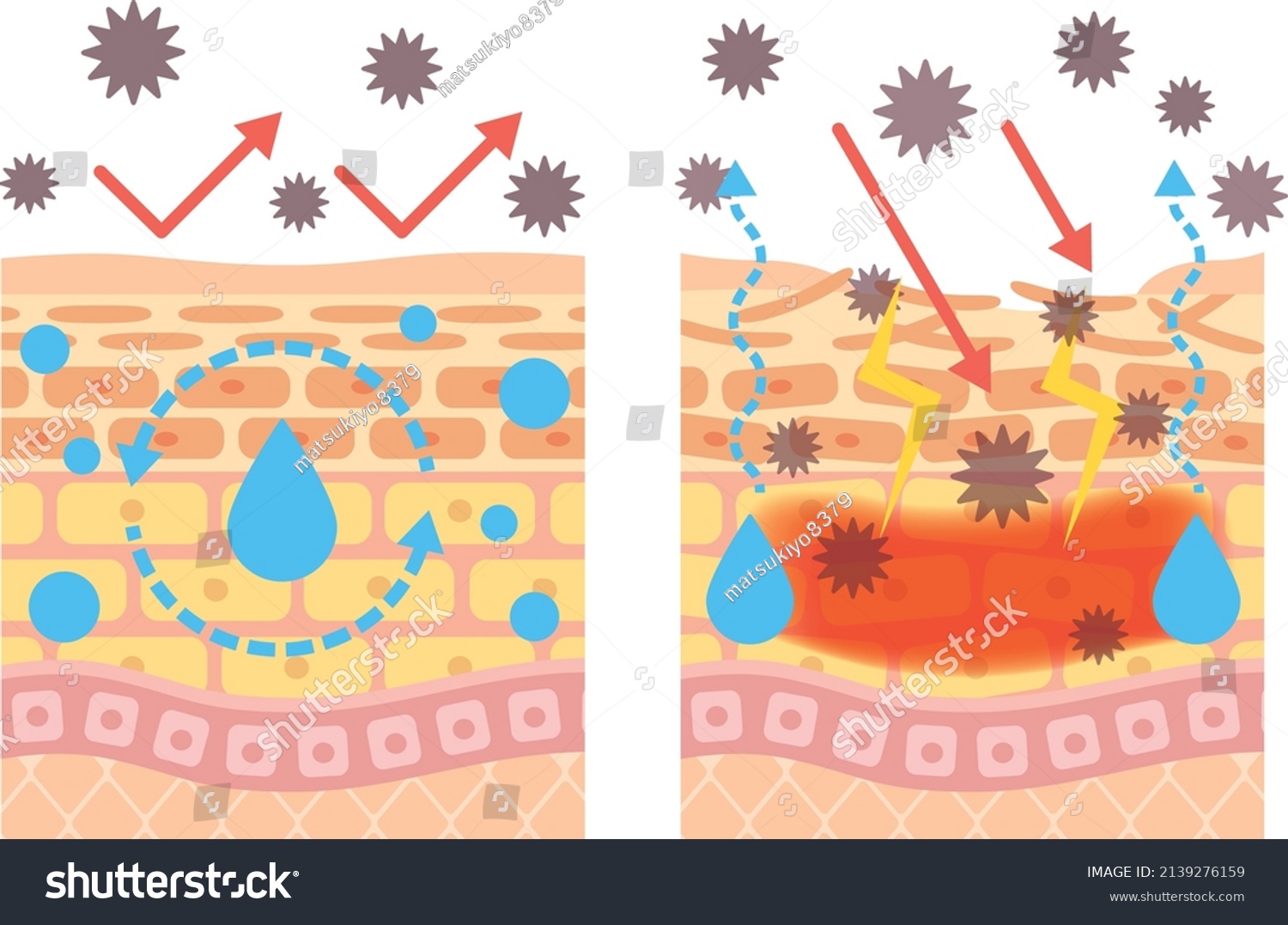 Structural Diagram Skin Atopic Dermatitis Stock Vector (royalty Free 