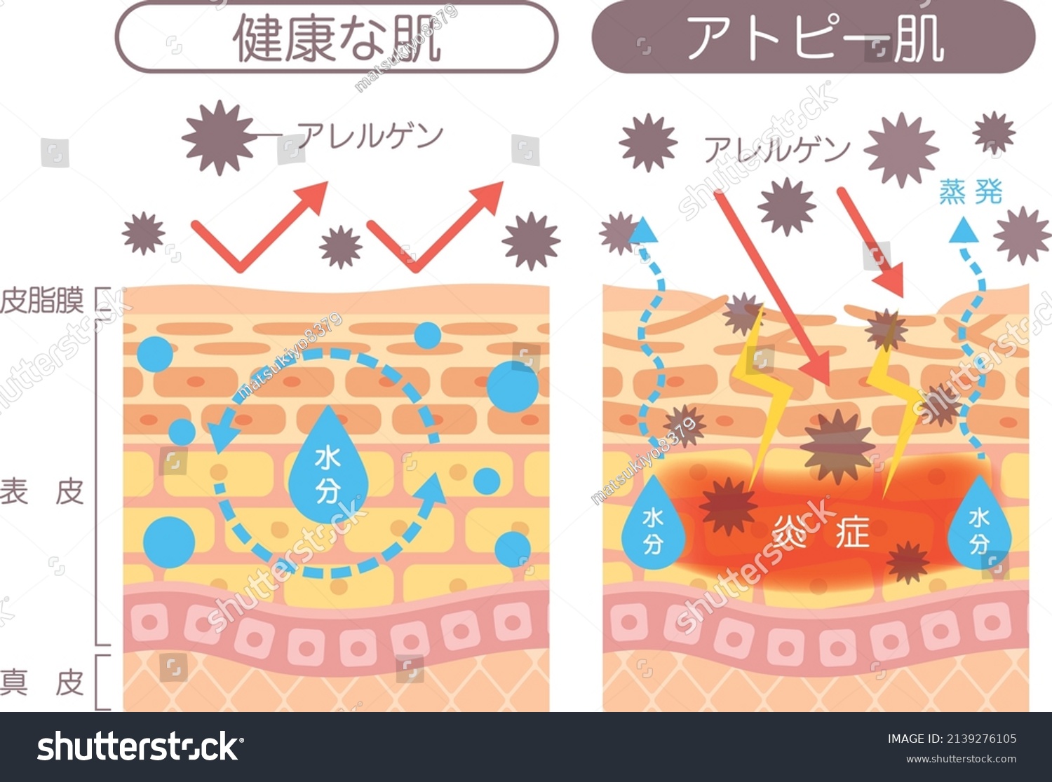 Structural Diagram Skin Atopic Dermatitis Described Stock Vector ...