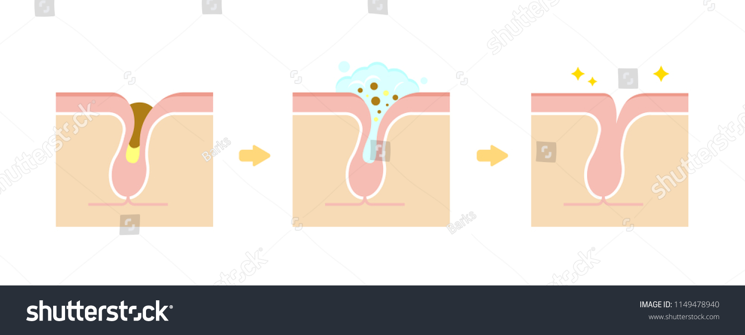 毛穴の構造イラスト 角栓 ホワイトヘッド ブラックヘッド とクレンジング のベクター画像素材 ロイヤリティフリー