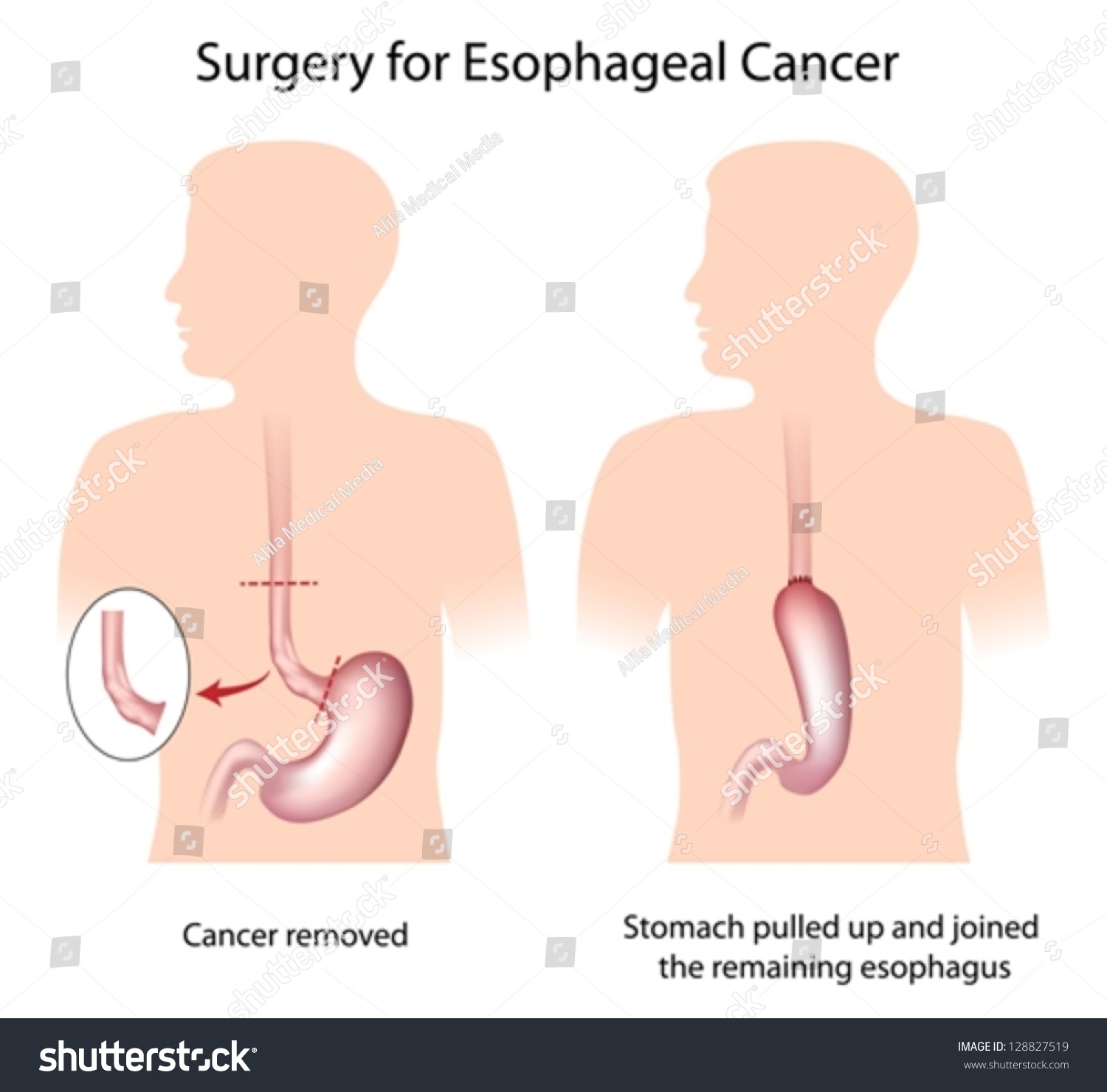 esophageal cancer 