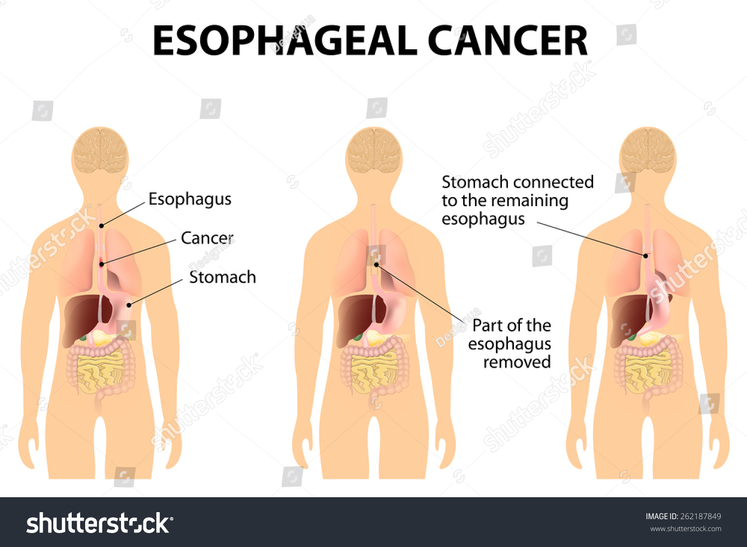 Surgery Remove Esophageal Cancer Affected Part Stock Vector 262187849 ...