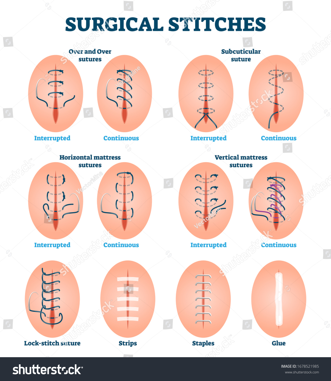 52-interrupted-suture-images-stock-photos-vectors-shutterstock