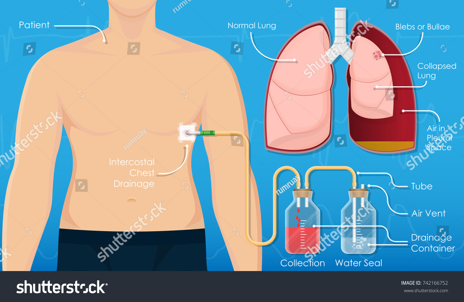 Symptom Spontaneous Iatrogenic Traumatic Pneumothorax Patient Stock Vector Royalty Free