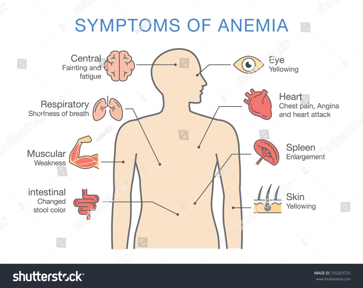 Symptoms Common Many Types Anemia Illustration Stock
