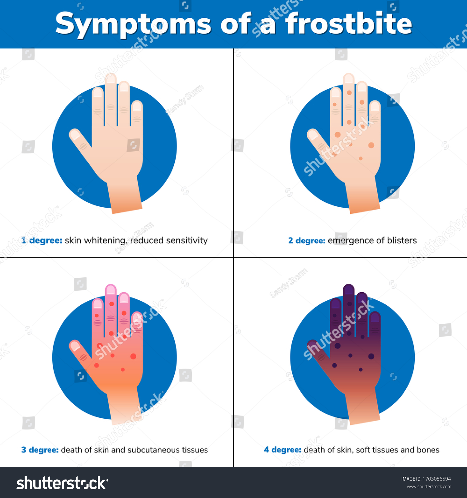 Symptoms Frostbite 4 Medical Stages Infographic Stock Vector (Royalty ...