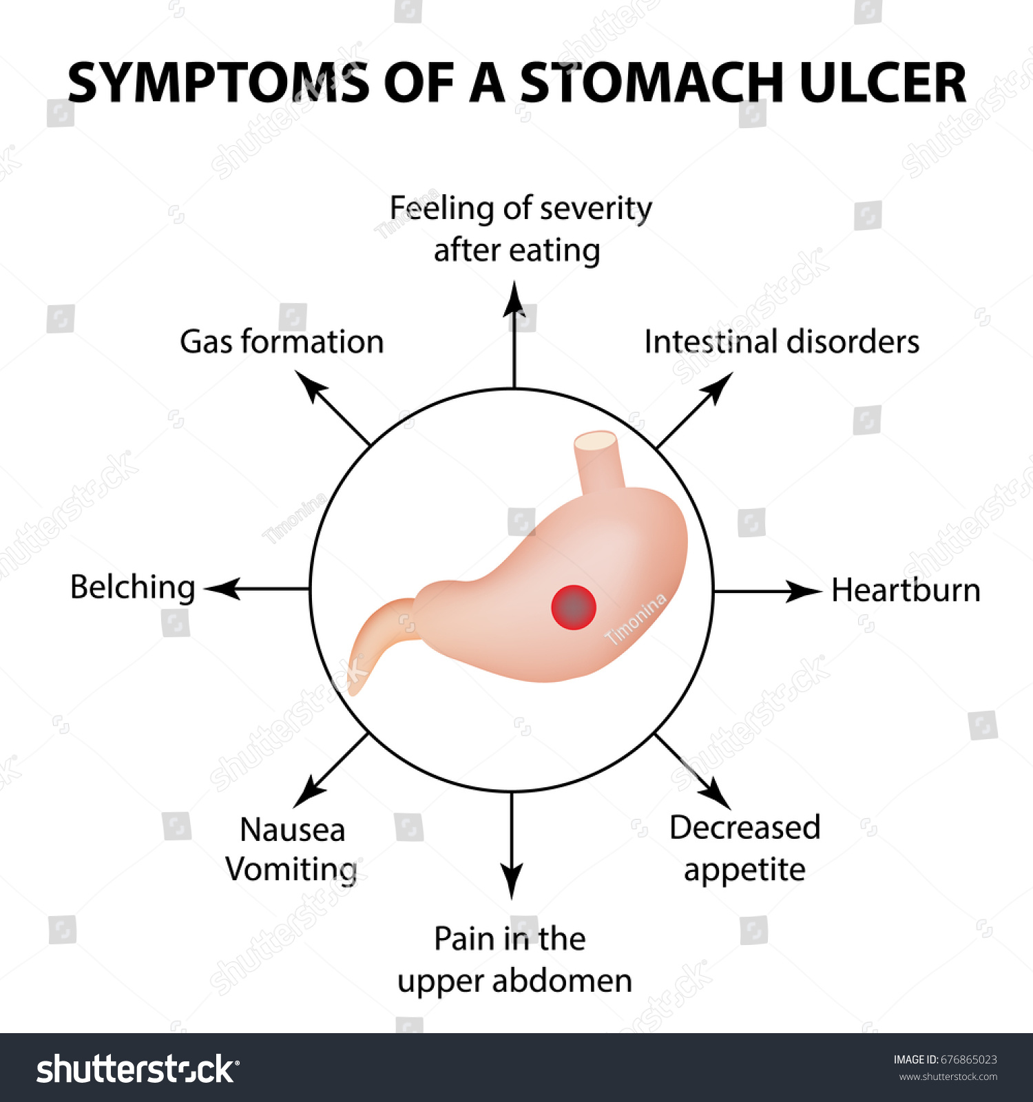 Symptoms Stomach Ulcer Infographics Vector Illustration Stock Vector 