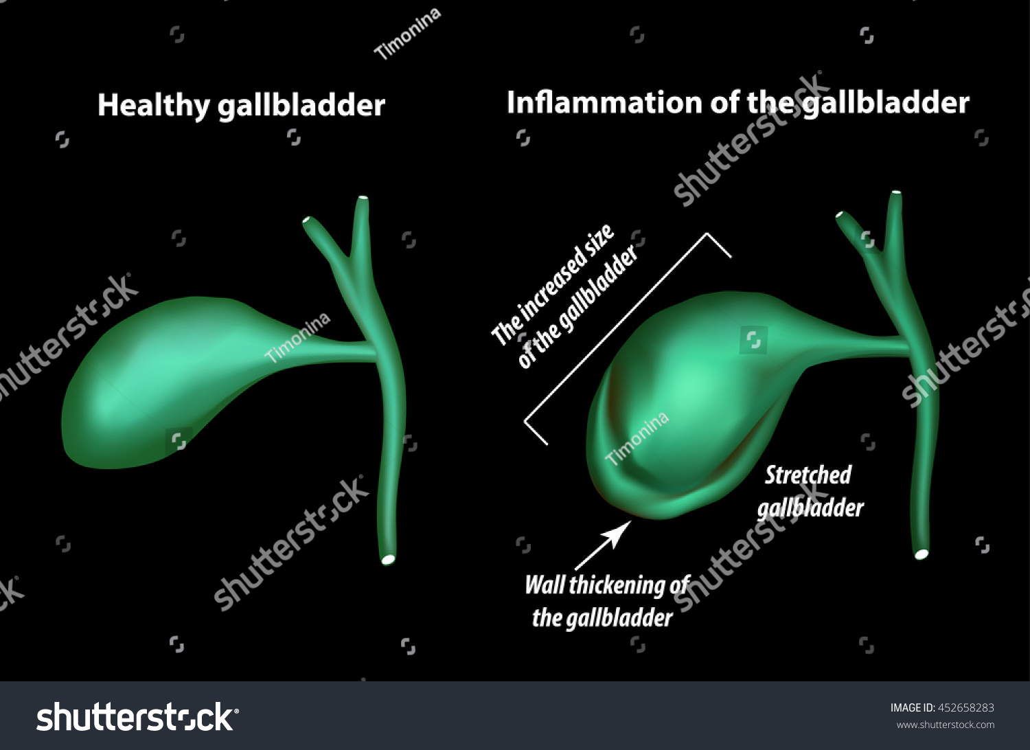 Bend of the gallbladder: causes, clinical manifestations, treatment Bend of the gallbladder: causes, clinical manifestations, treatment