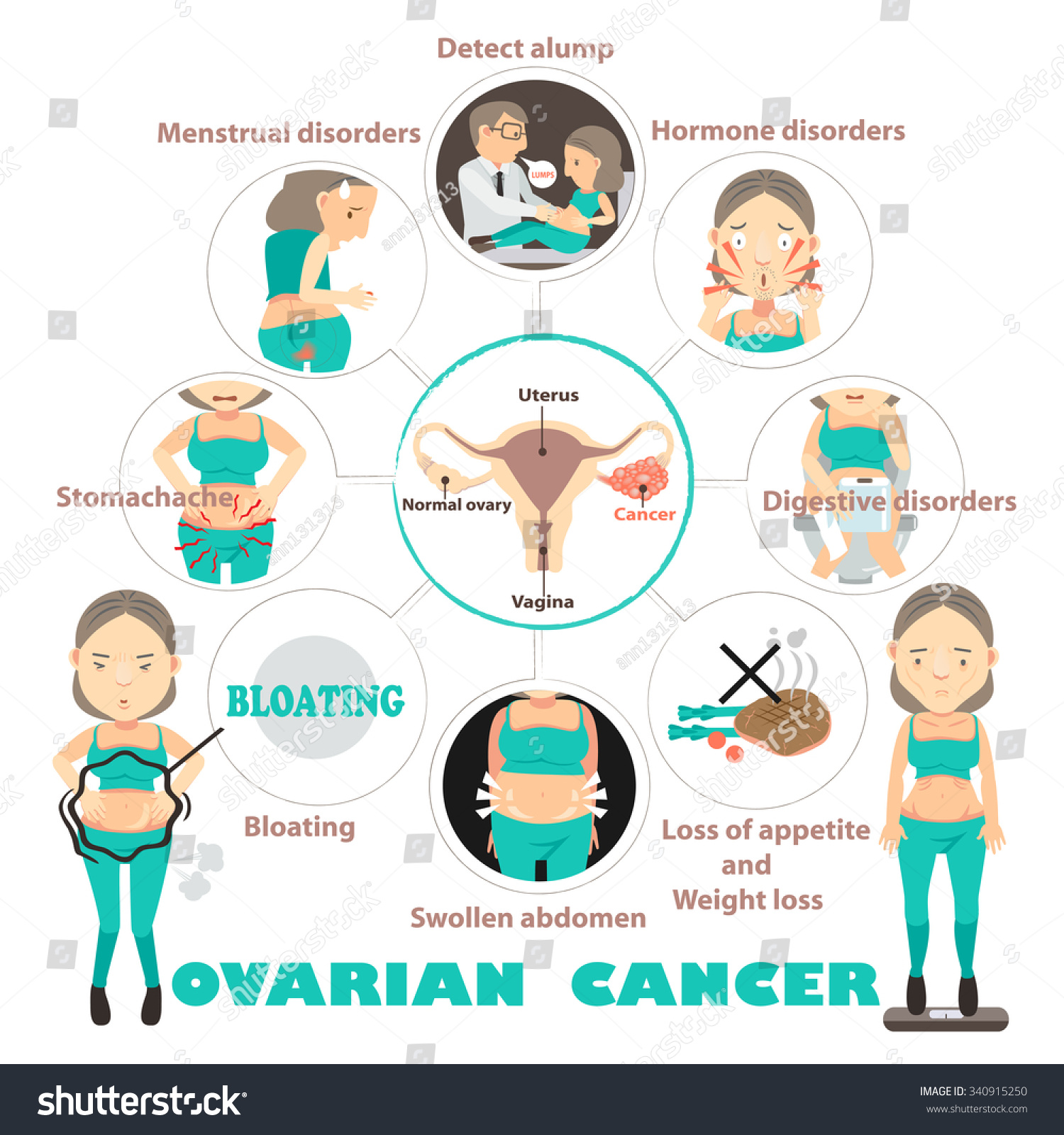 Symptoms Of Ovarian Cancer In Circles,Info Graphic Vector Illustration ...