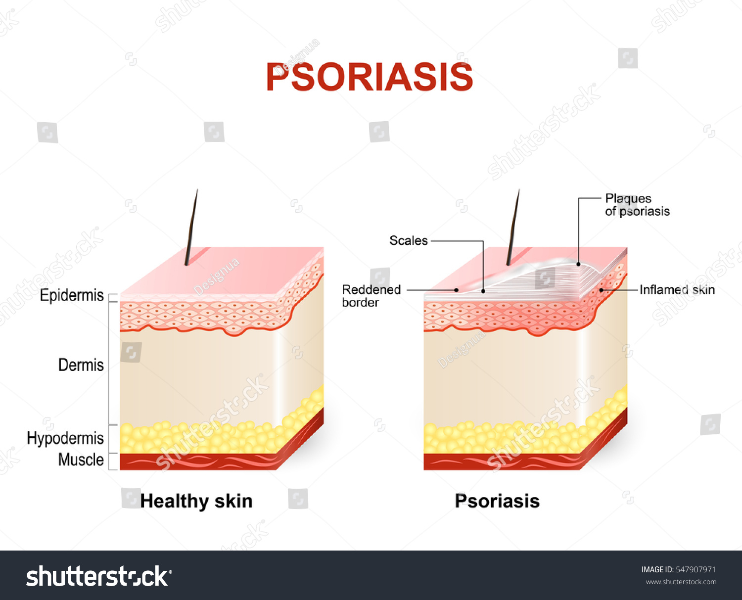 Symptoms Psoriasis Normal Skin Psoriasis Plaque Stock Vector (Royalty ...