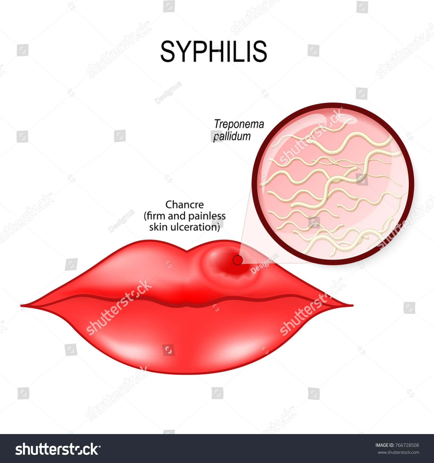 Syphilis Syphilis Symptoms,