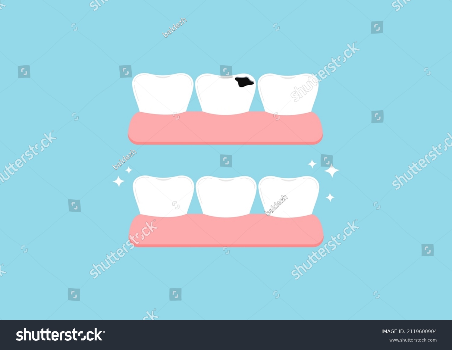 Teeth Before After Decay Gym Dental Stock Vector (Royalty Free) 2119600904