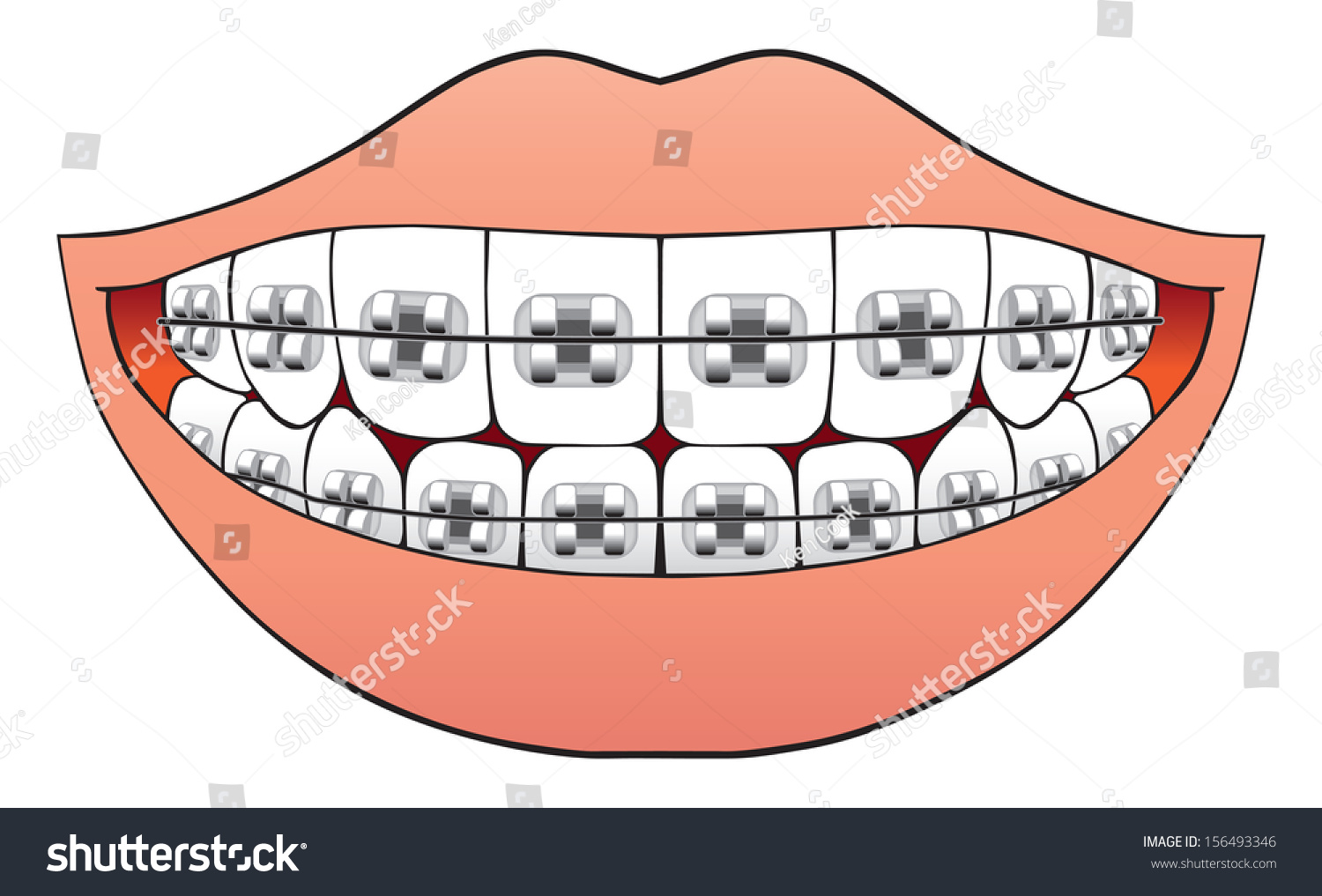 Teeth Braces Stock Vector (Royalty Free) 156493346