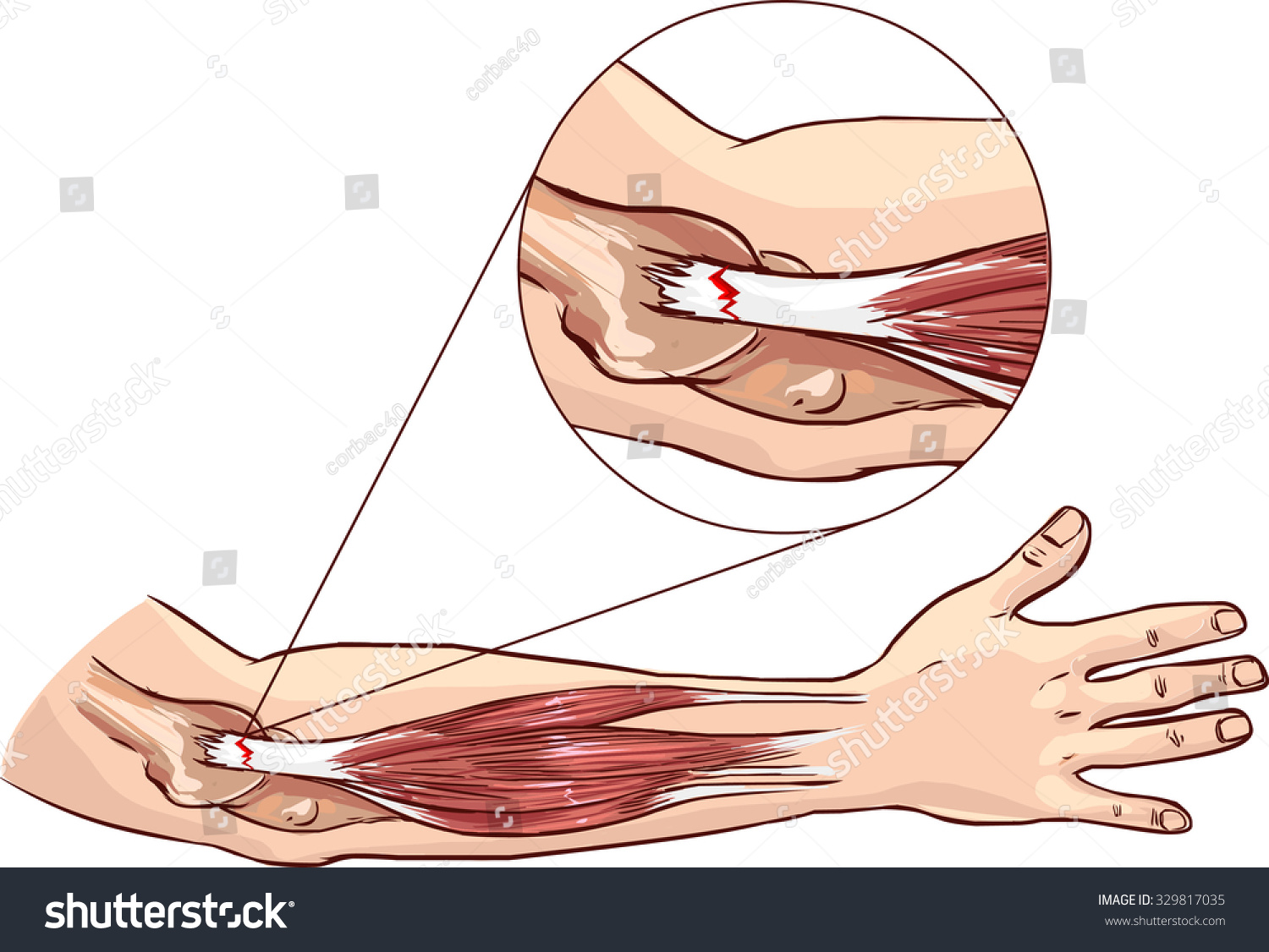 Tennis Elbow Tear Common Extensor Tendon Stock Vector Royalty Free 329817035