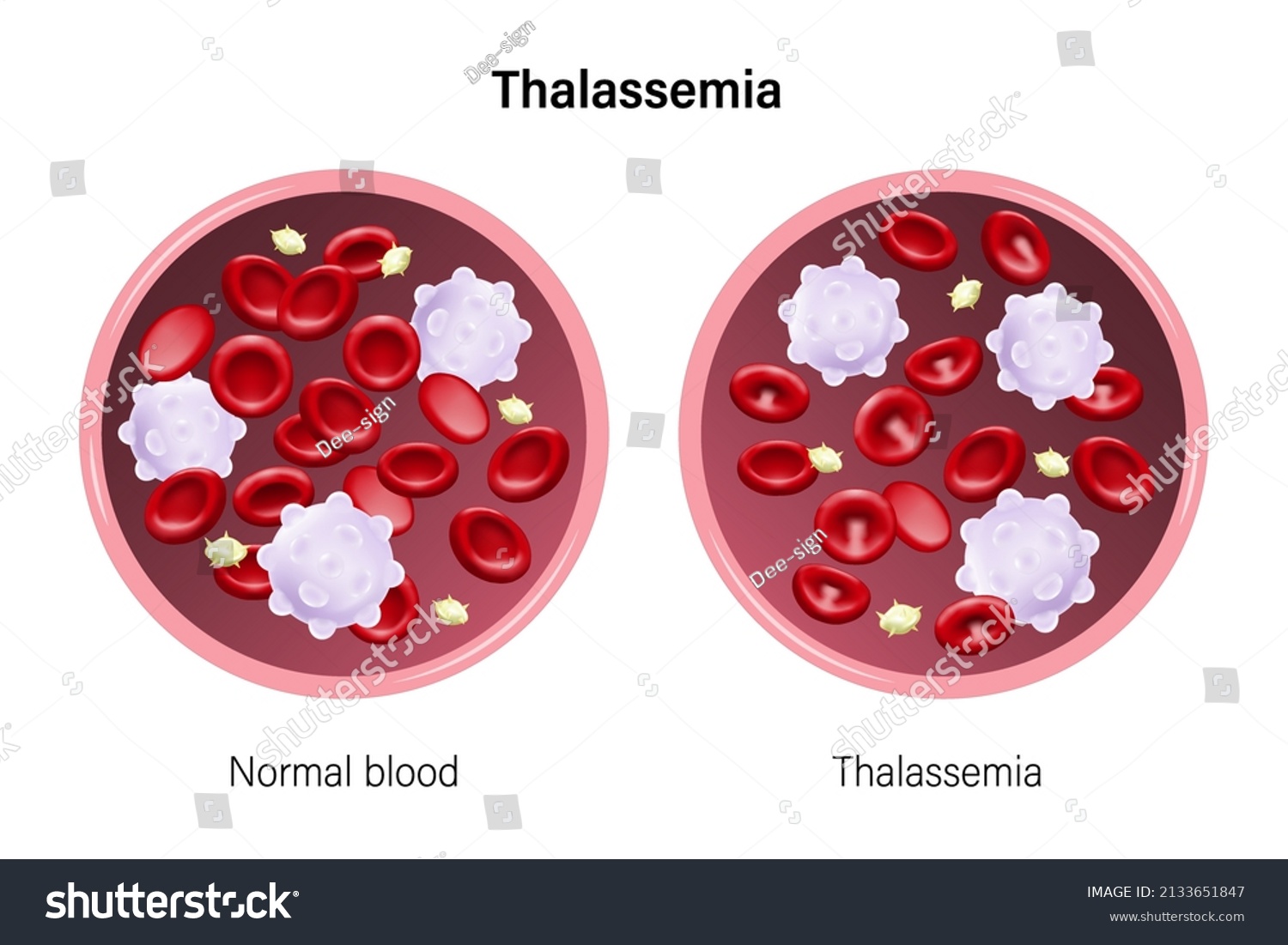 Thalassemia Difference Blood Thalassemia Normal Blood Stock Vector