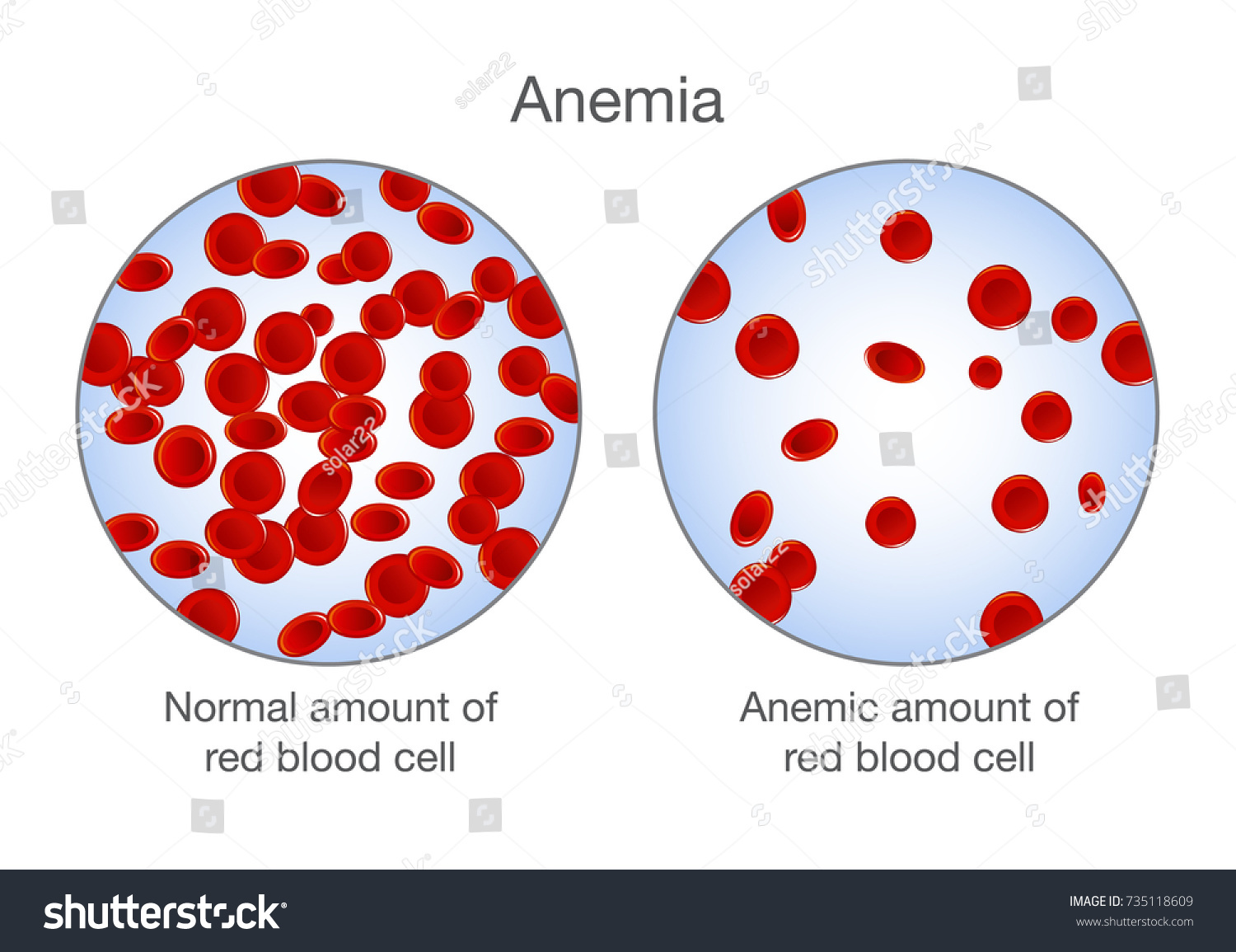 735118609 Shutterstock anemia-morphological-classification-the-blood-project