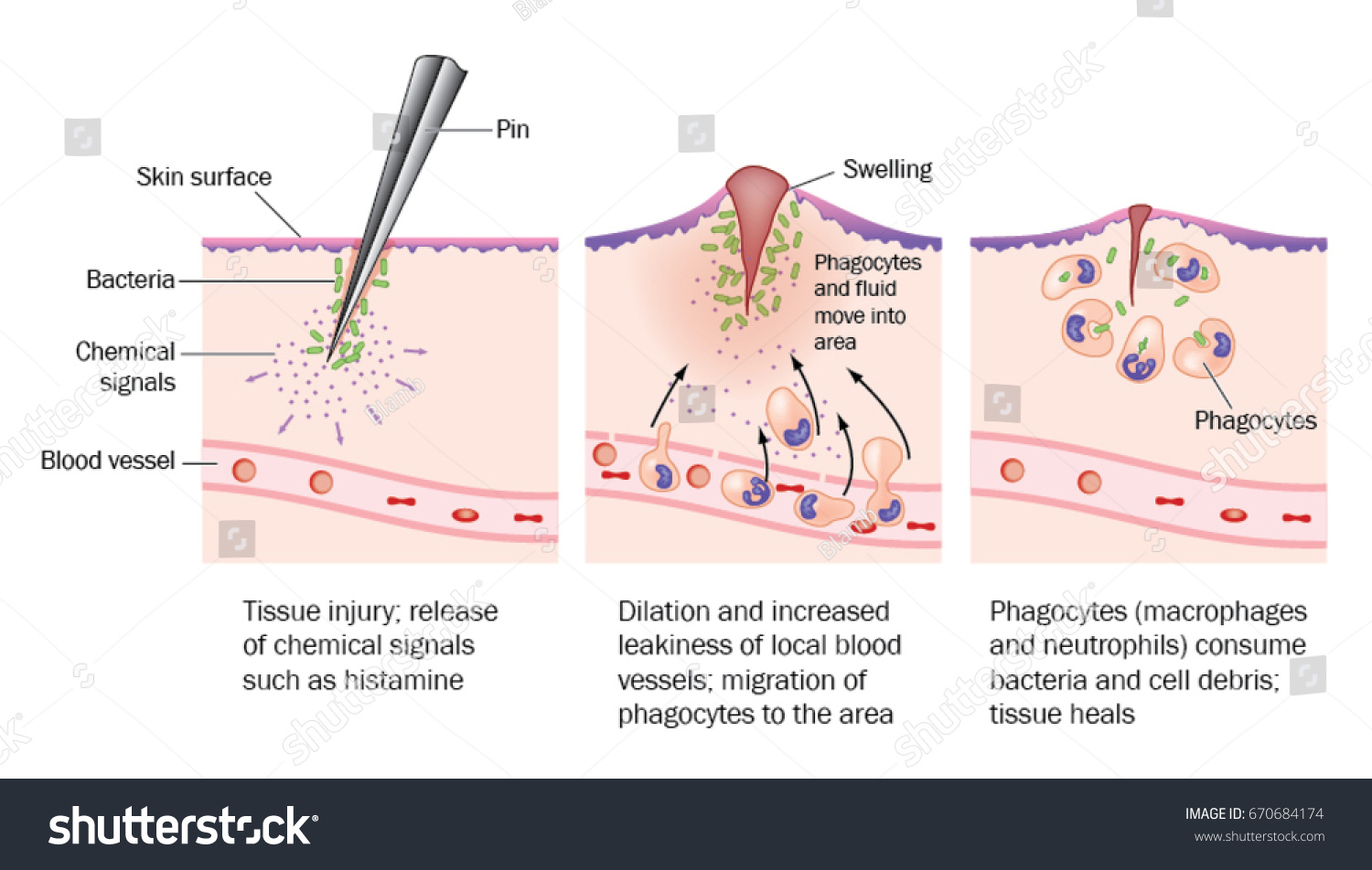 Inflammation process Images, Stock Photos & Vectors | Shutterstock