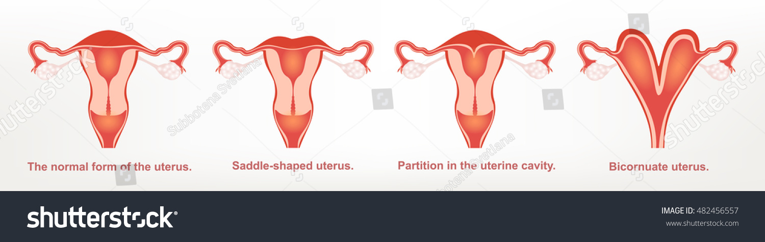 The Shape Of The Uterus, The Female Reproductive Organ. Stock Vector ...