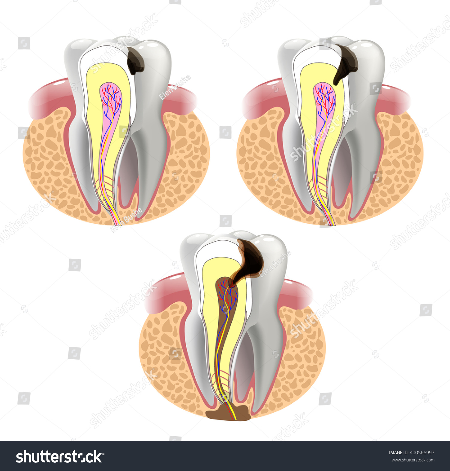 Stages Caries Development Vector De Stock Libre De Regalías 400566997 1521