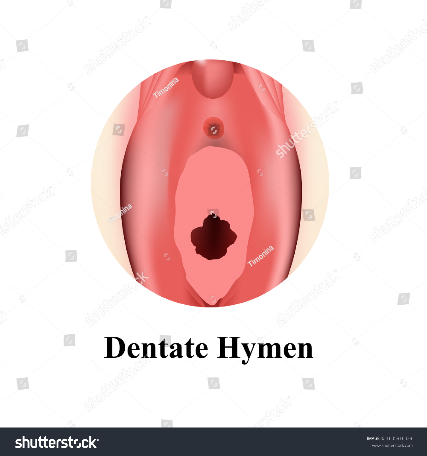 Structure Vulva Hymen Dentate Hymen After Stock Vector Royalty Free