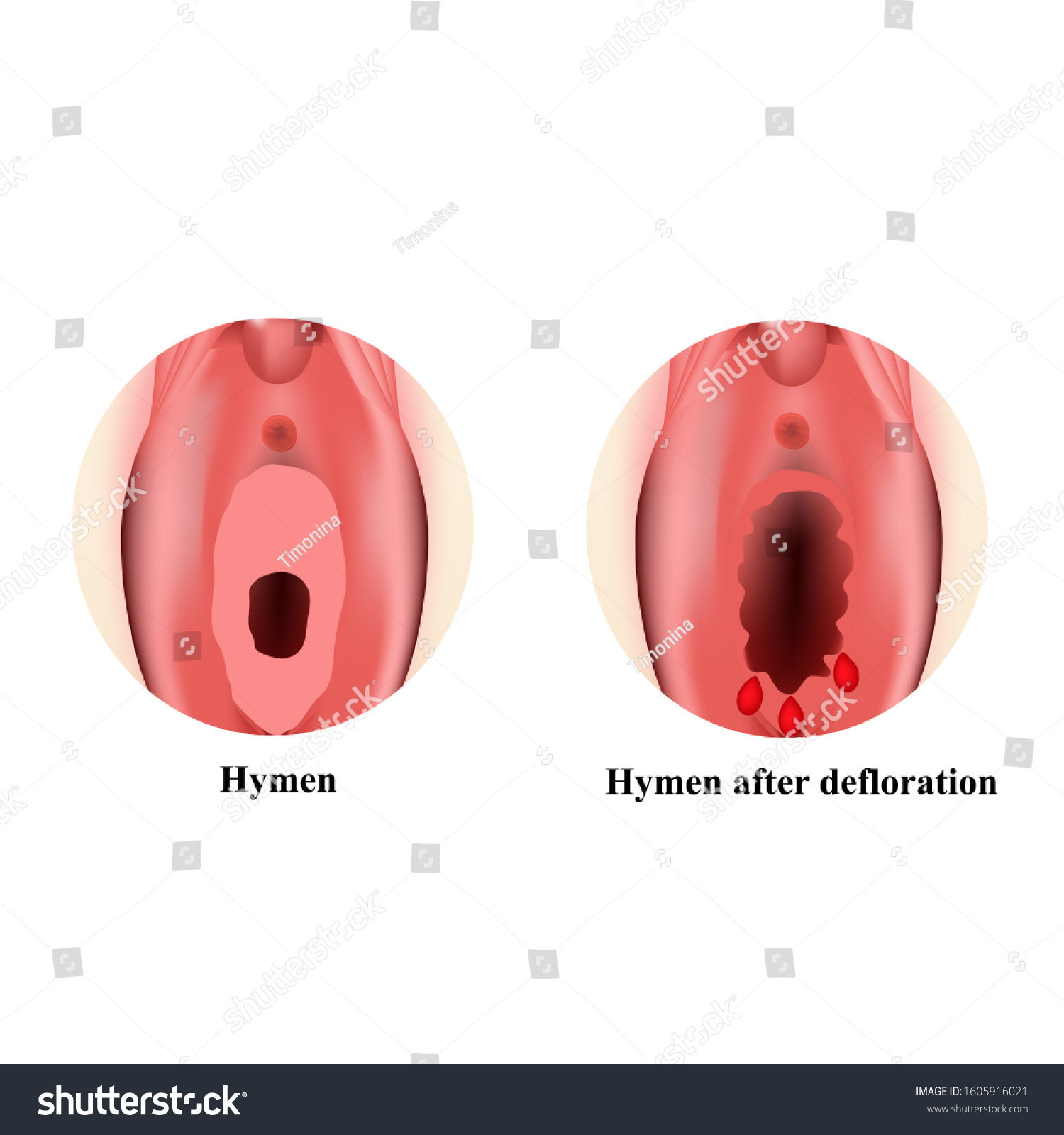 Hymen