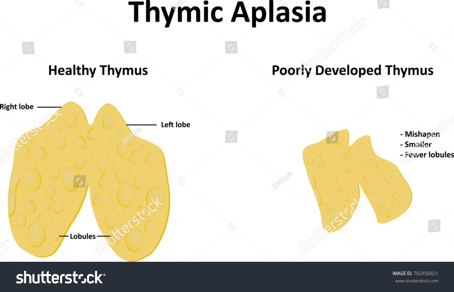 Thymic Aplasia Stock Vector (Royalty Free) 702450421 | Shutterstock