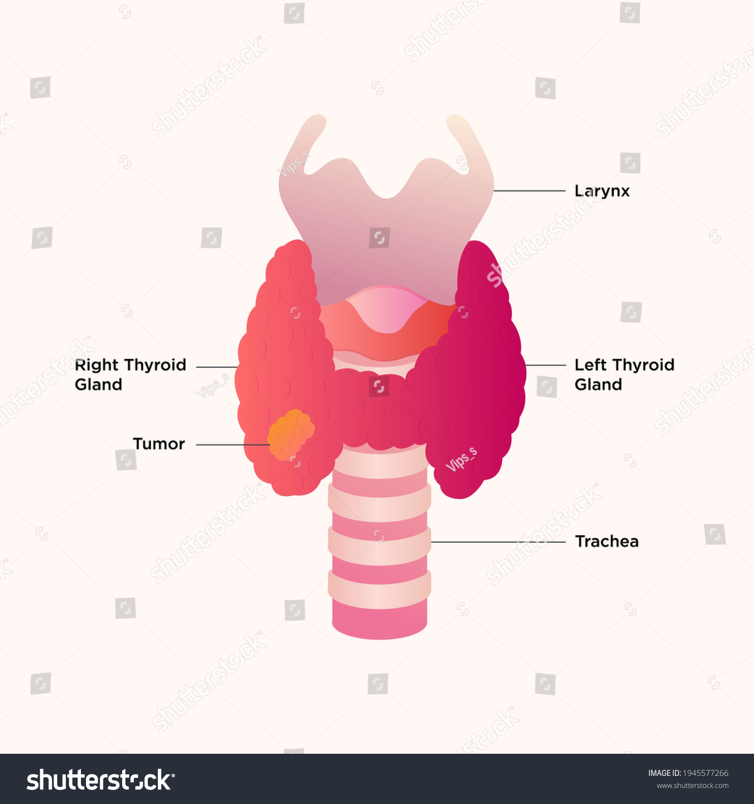 Thyroid Gland Larynx Diagram Thyroid Cancer Stock Vector (Royalty Free ...