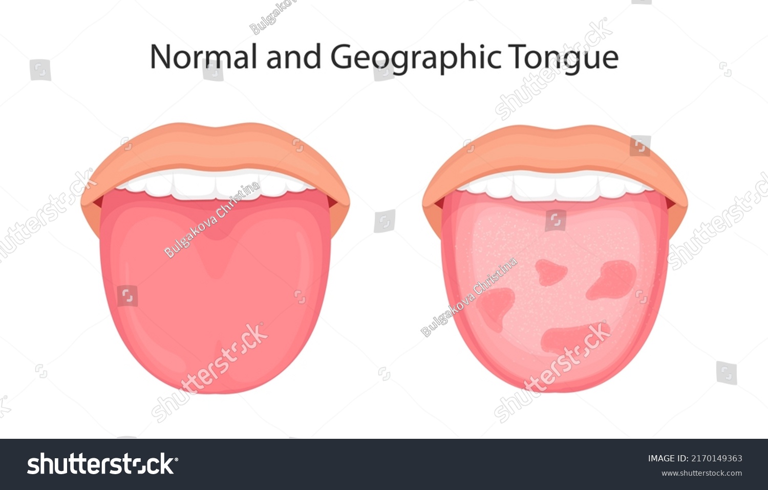 Tongue Disease Organs Concept Vector Stock Vector (Royalty Free ...